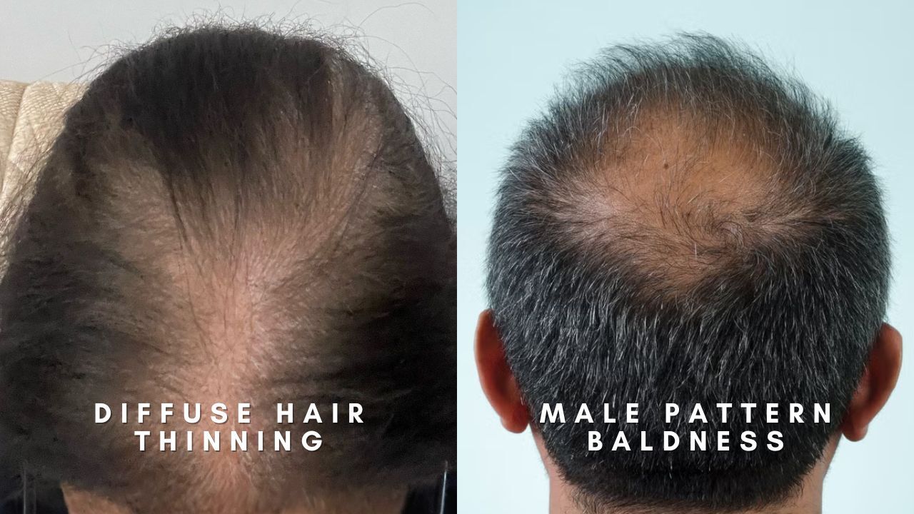 Diffuse hair thinning vs male pattern baldness