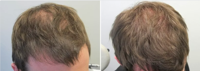 minoxidil before and after minimal