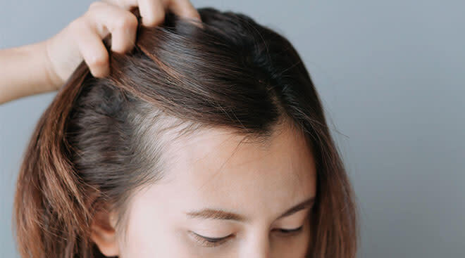 postpartum hair loss