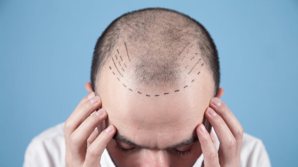 saw palmetto for hair growth