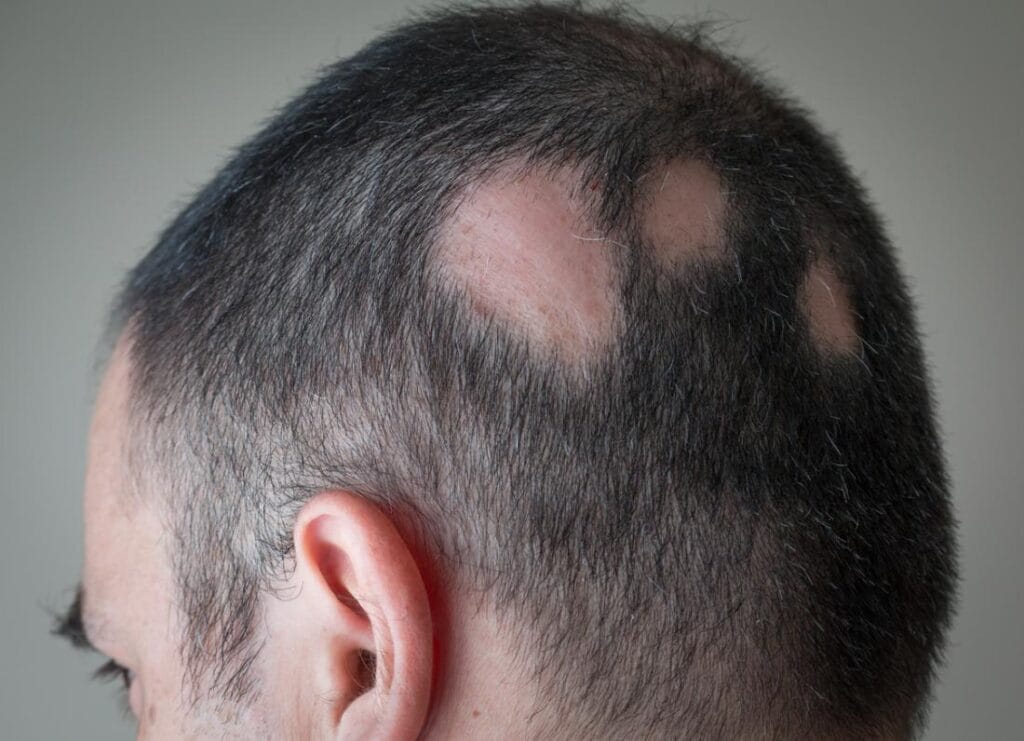 quitting minoxidil effects
